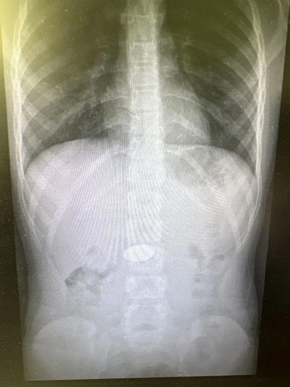 Чудо в Волгограде! Врачи спасли малыша, проглотившего 5-рублёвую монету! 🫣