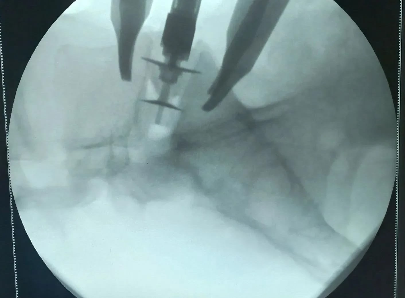 Без разреза на спине: волгоградские нейрохирурги осваивают новый подход к грыжам позвоночника.