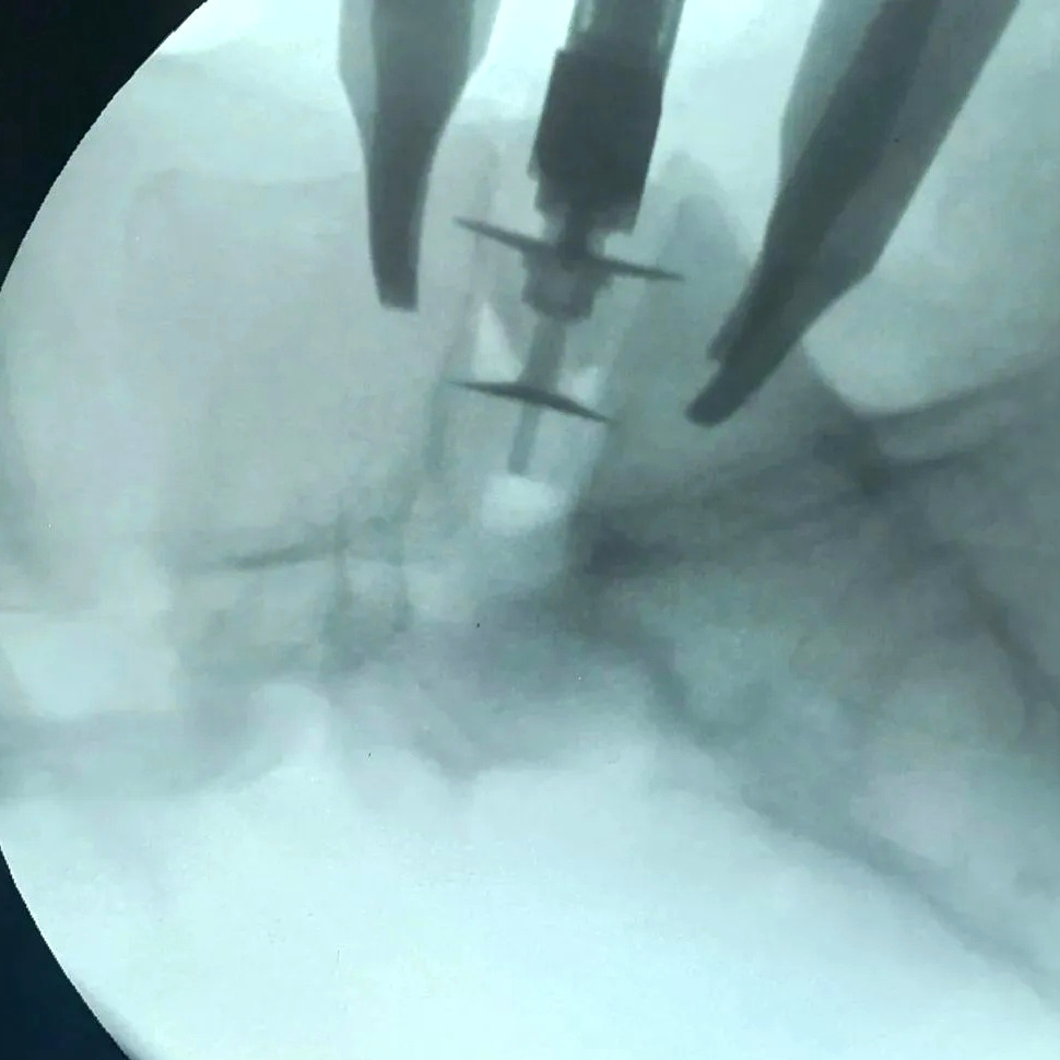 «Новаторство в нейрохирургии!» В Волгограде внедряют новый передовой метод лечения грыж межпозвонковых дисков! 👏🤩