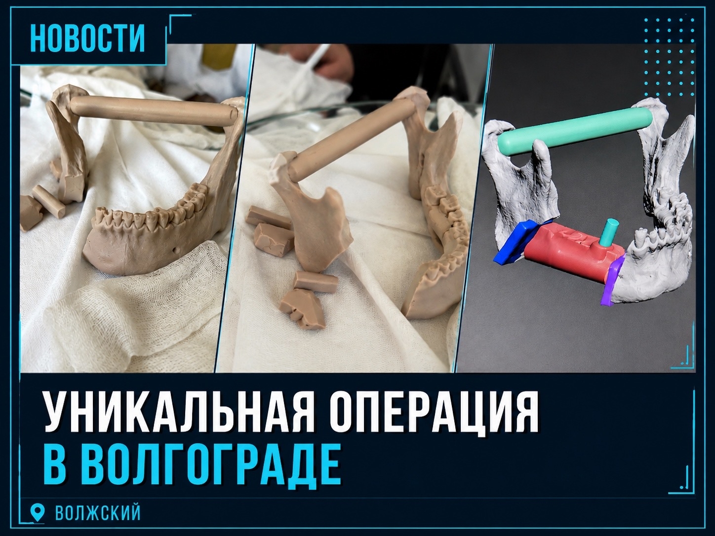 🦷 В Волгограде впервые восстановили нижнюю челюсть в ходе 15-часовой операции