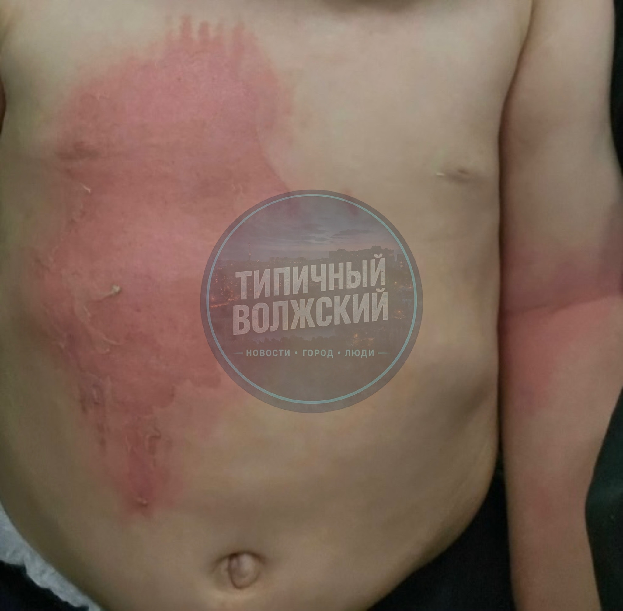 😱 Ребёнок получил ожог второй степени в детской поликлинике №2 Волжского